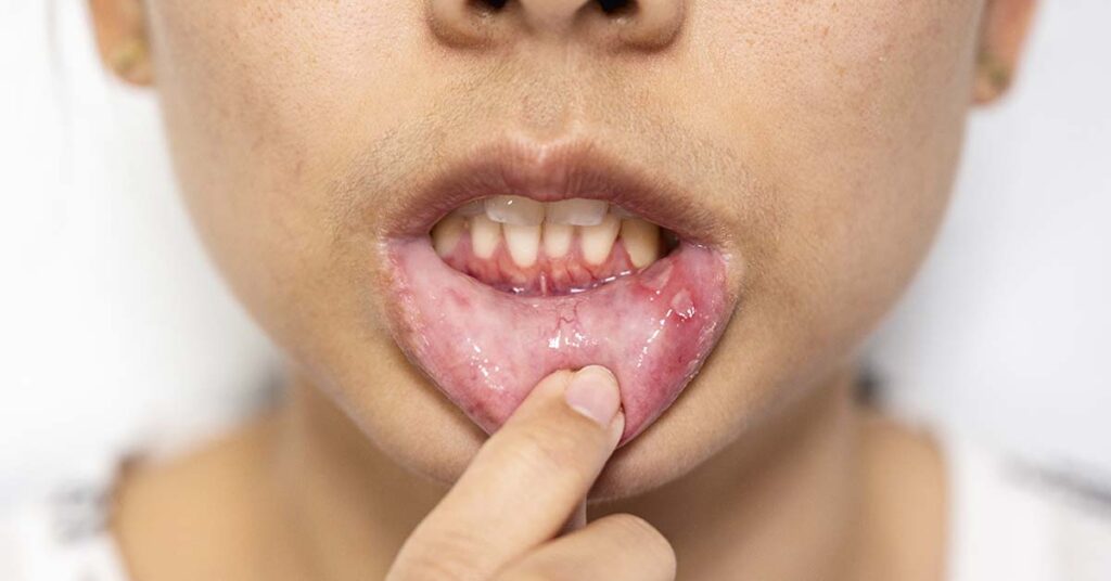 Aftas recorrentes: por que aparecem e como prevenir